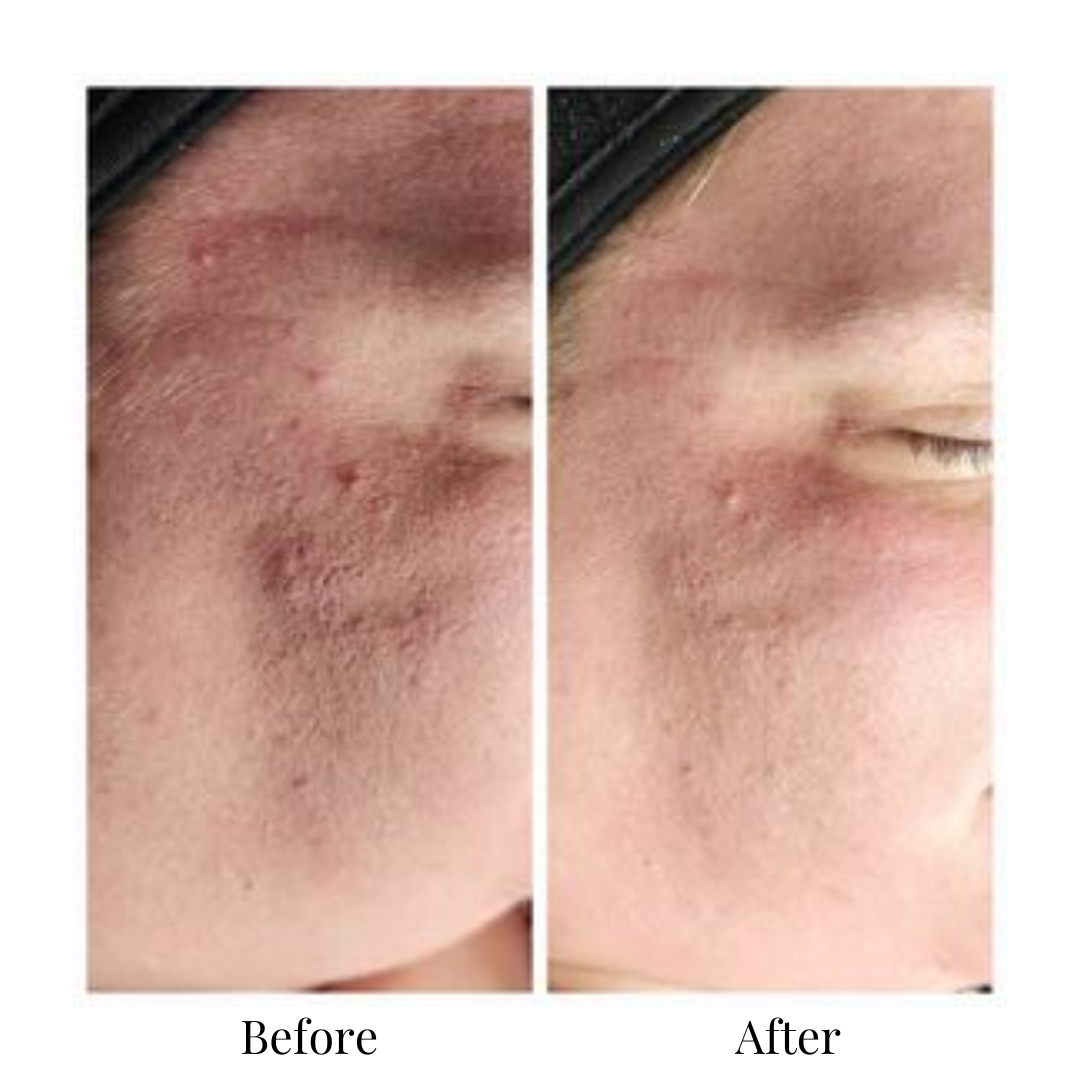 microdermabrasion edmonton clinic