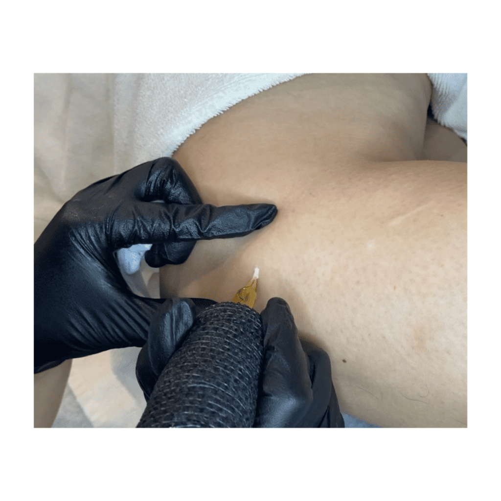 Medical skin Camouflage in Edmonton. This is also known as medical tattooing usually performed on scars.
