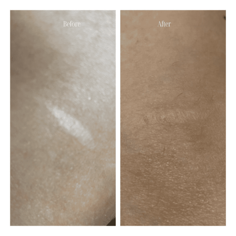 medical camouflage in edmonton before and after