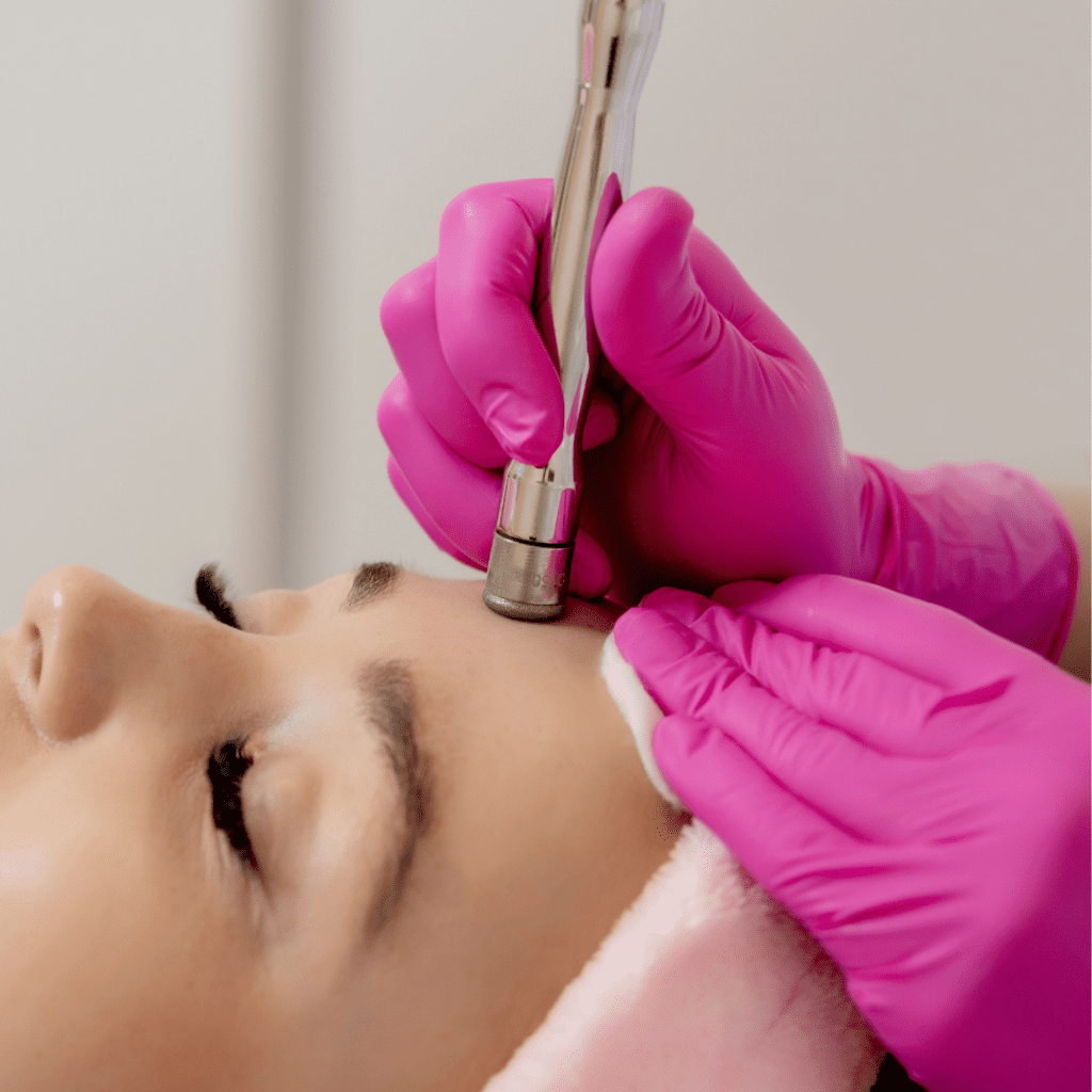 skin resurfacing done by microdermabrasion in Edmonton
