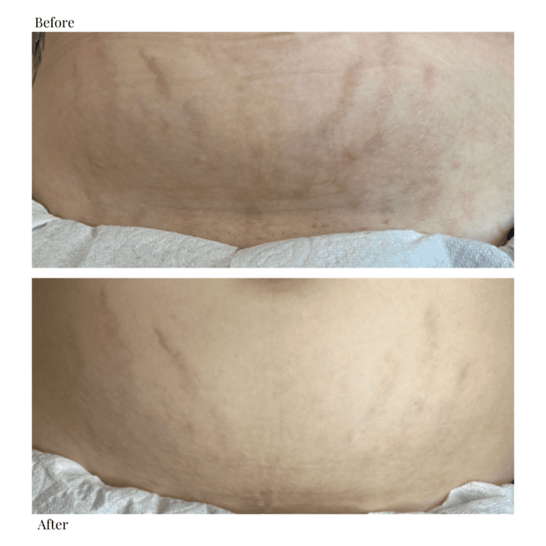 medical tattooing to cover up scars and stretch marks in edmonton