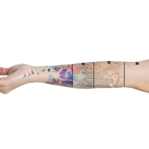 Can a tattoo be 100 percent removed?