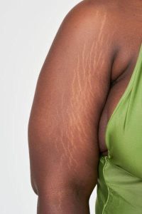 stretch mark removal edmonton